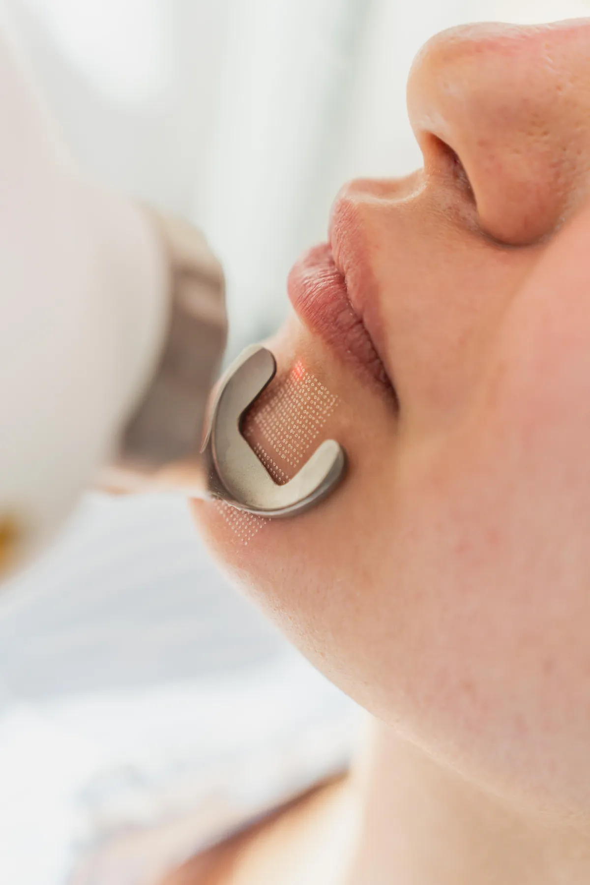 Fraktionierte Laserbehandlung im Gesicht – Fotona 4D in der Ordination von Dr. Nicole Egger