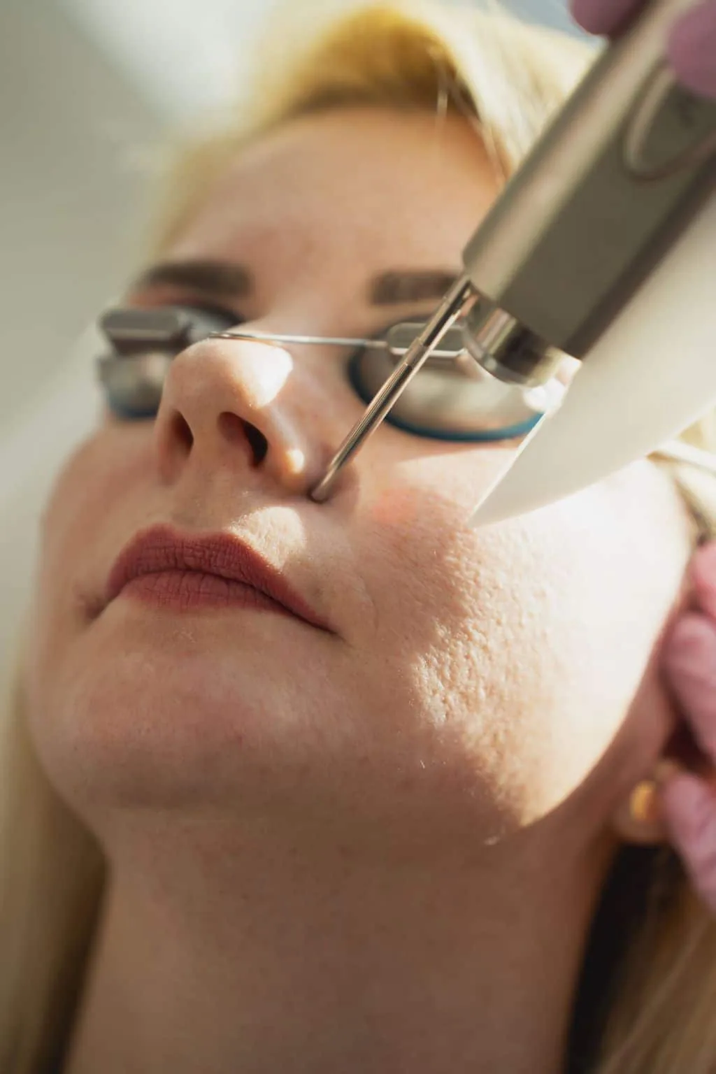 Fractional-Laser-Behandlung im Gesicht einer Patientin mit Schutzbrille