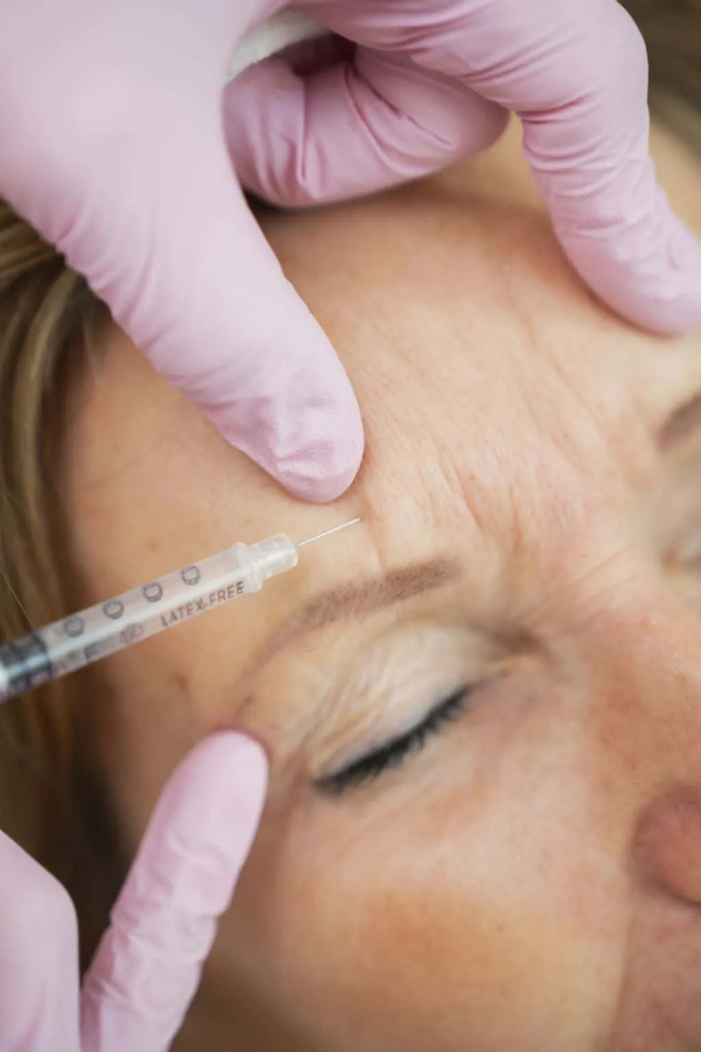 Botox-Behandlung durch Dr. Nicole Egger in Wien