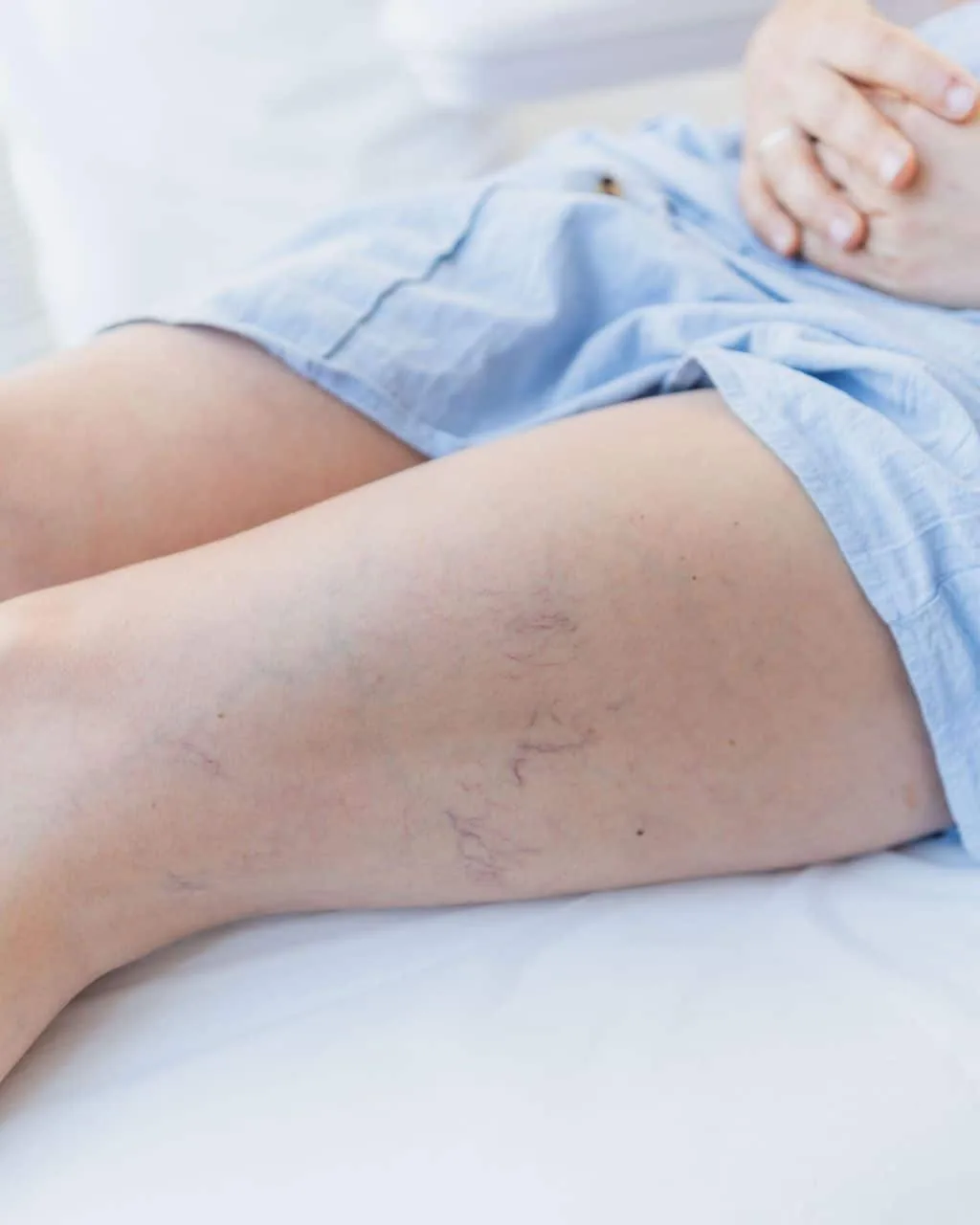 Laserbehandlung von Besenreisern am Bein