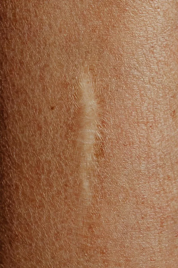 Hautnarbe nach Laserbehandlung in Nahaufnahme