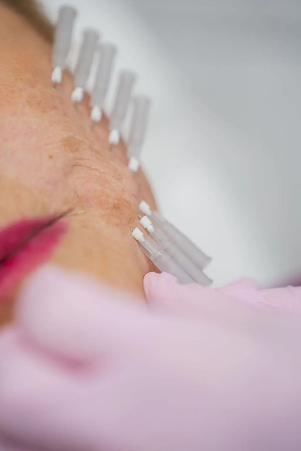 PDO-Fadenlifting-Behandlung in Nahaufnahme
