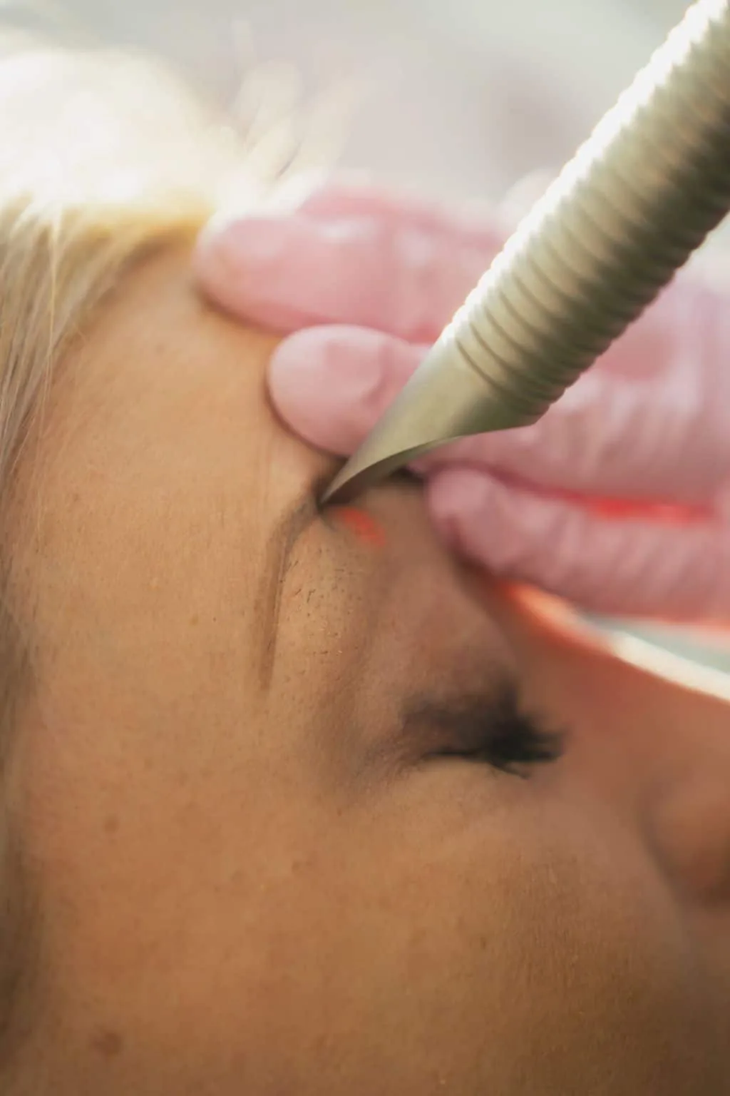 Mesotherapie der Augenpartie mit NCTF